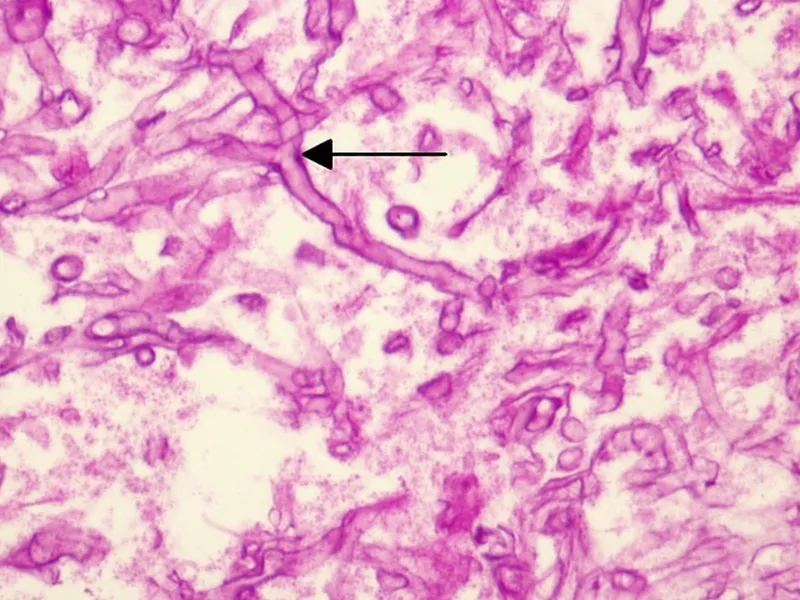 Mucormycosis histology: broad nonseptate hyphae