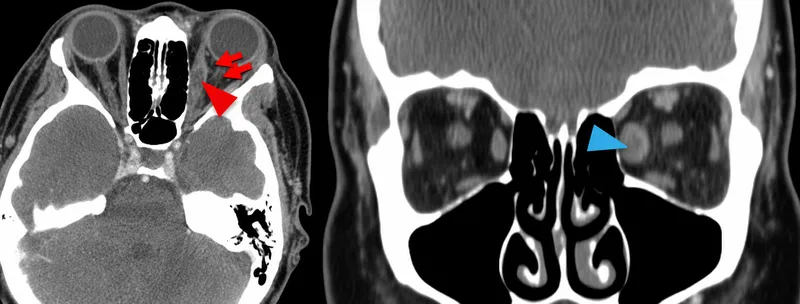 Axial and coronal CT showing orbital myositis