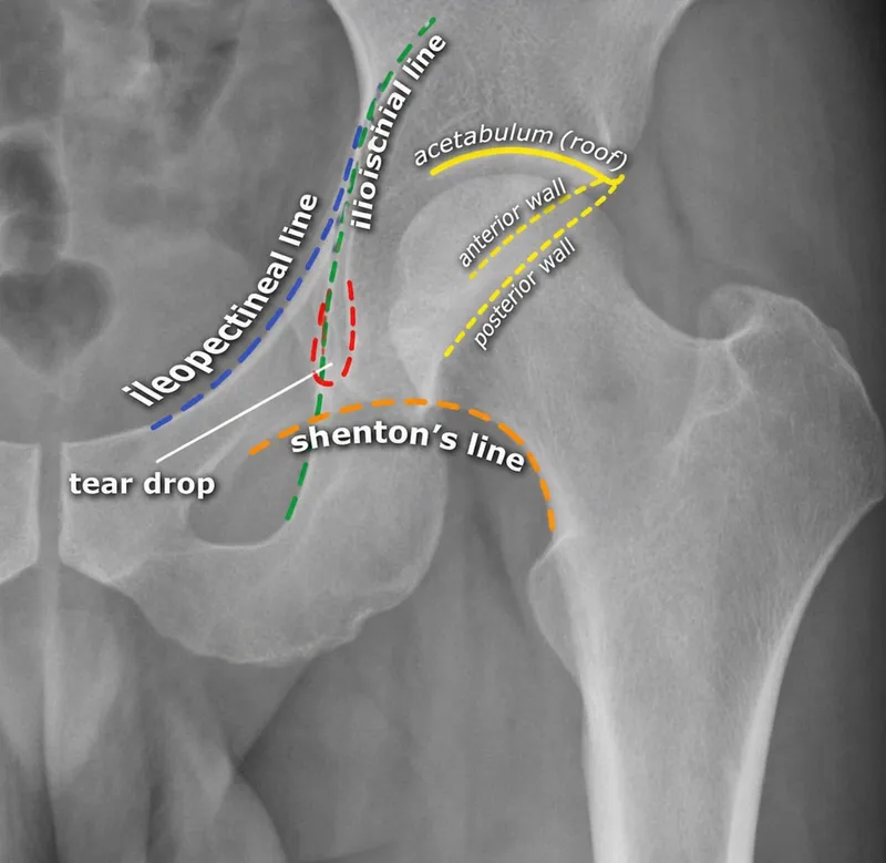 Pelvic Radiologic Landmarks on AP Hip X-ray