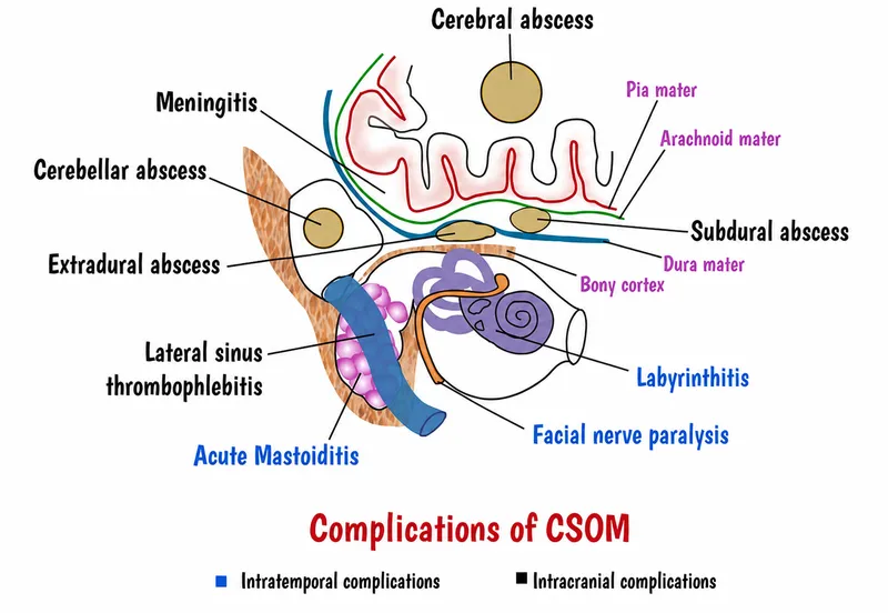 Intracranial Complications of Otitis Media Diagram