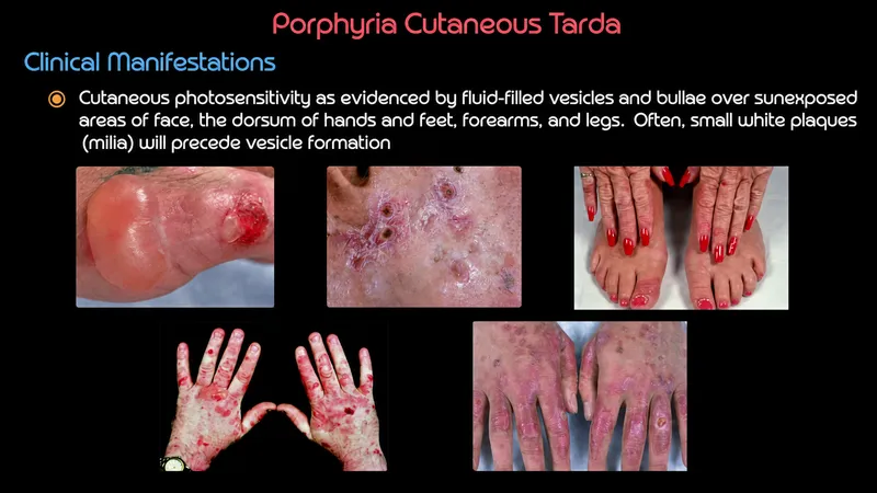 Porphyria Cutanea Tarda Clinical Manifestations