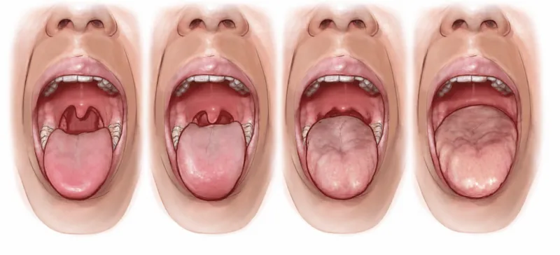 Mallampati Airway Classification Classes I-IV