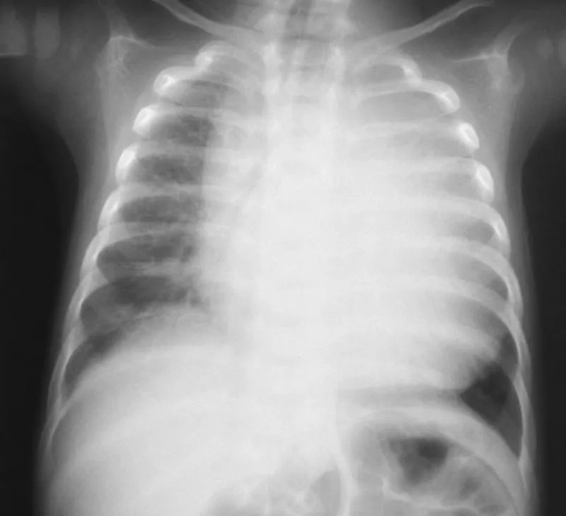 Cardiomegaly on chest X-ray in Pompe disease