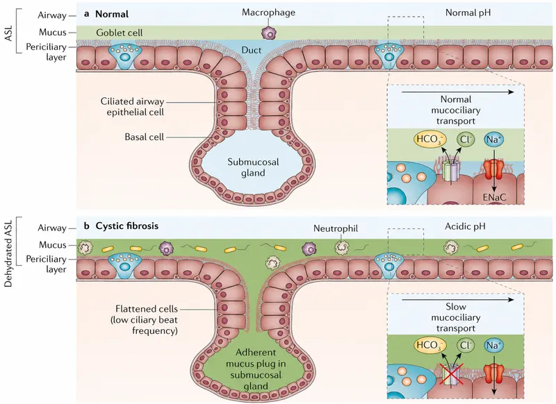 Cystic Fibrosis Airway vs. Normal Airway