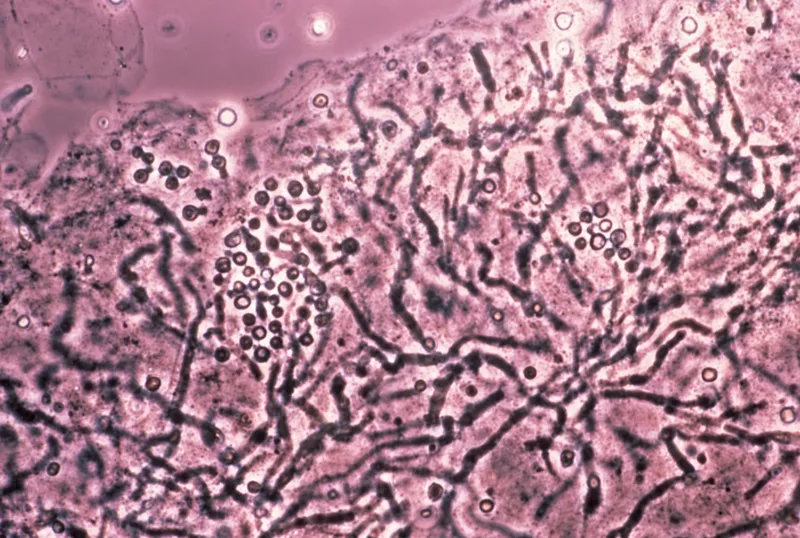 KOH prep of tinea versicolor showing hyphae and yeast