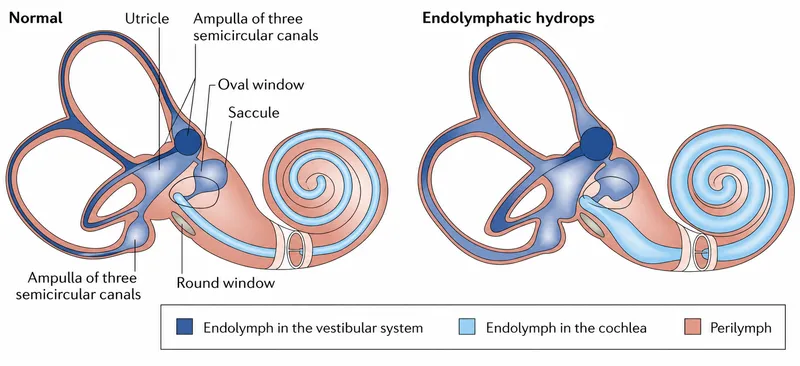 Endolymphatic hydrops in Ménière's disease vs normal ear