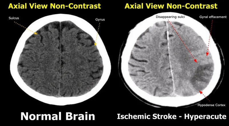 Axial CT: Normal brain vs hyperacute ischemic stroke