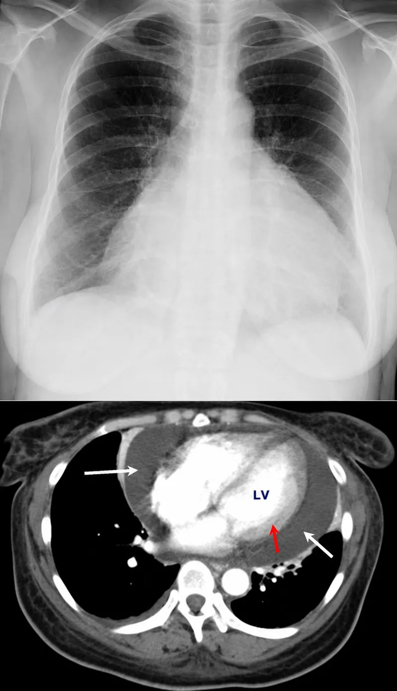 Pericardial Effusion: CXR Water Bottle Sign & CT
