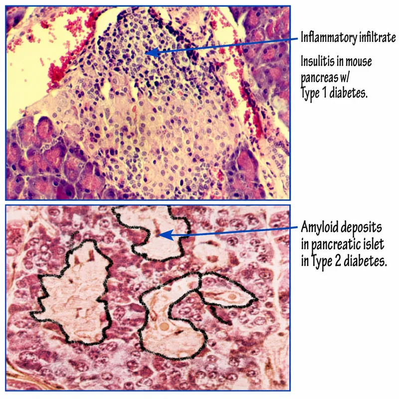 Insulitis in Type 1 vs Amyloid in Type 2 Diabetes