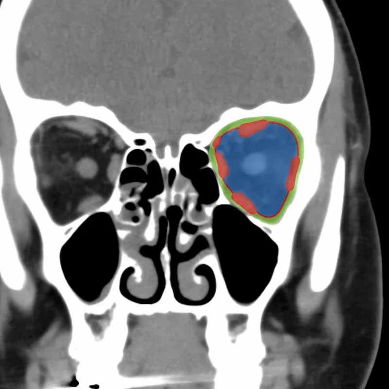 Coronal CT showing orbital spaces