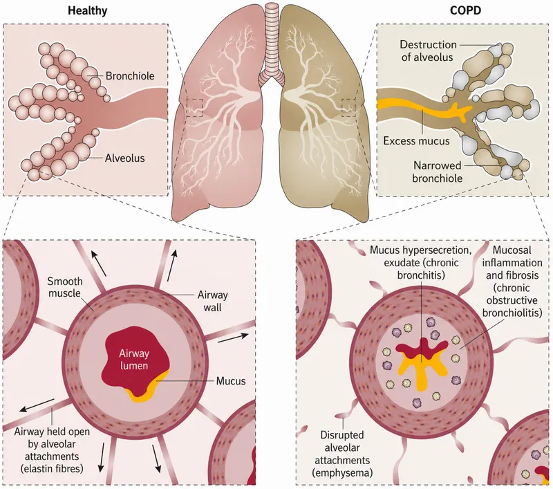 Healthy vs COPD airway cross-section