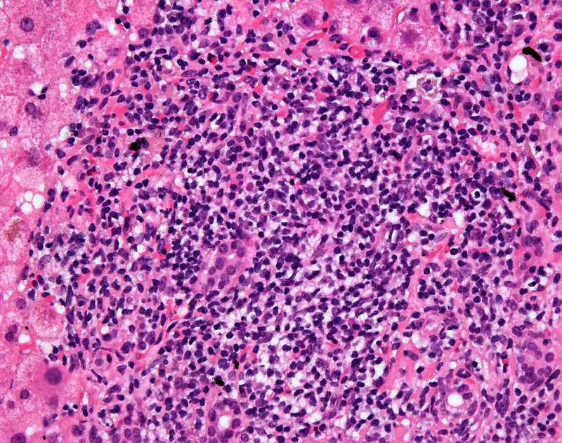 Histology of Autoimmune Hepatitis with Interface Hepatitis