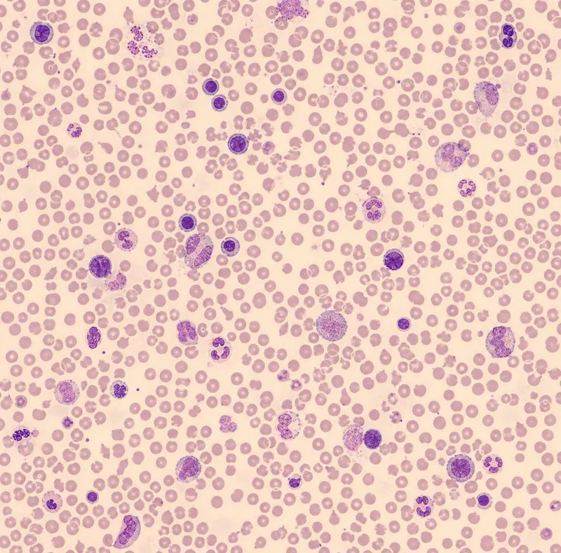 Peripheral smear in Primary Myelofibrosis