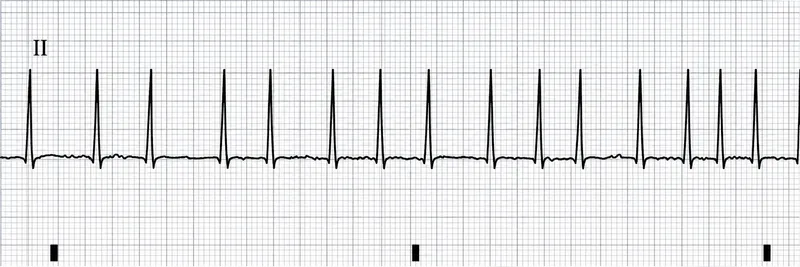 EKG: Atrial Fibrillation with Rapid Ventricular Response