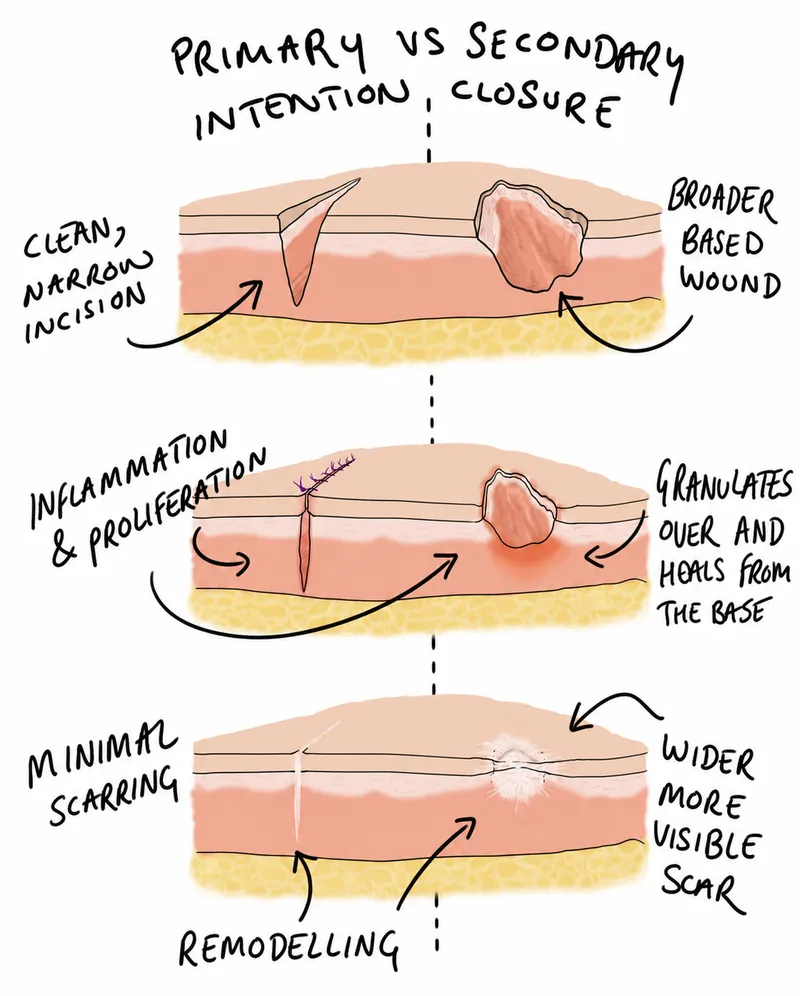 Primary vs. Secondary Intention Wound Healing