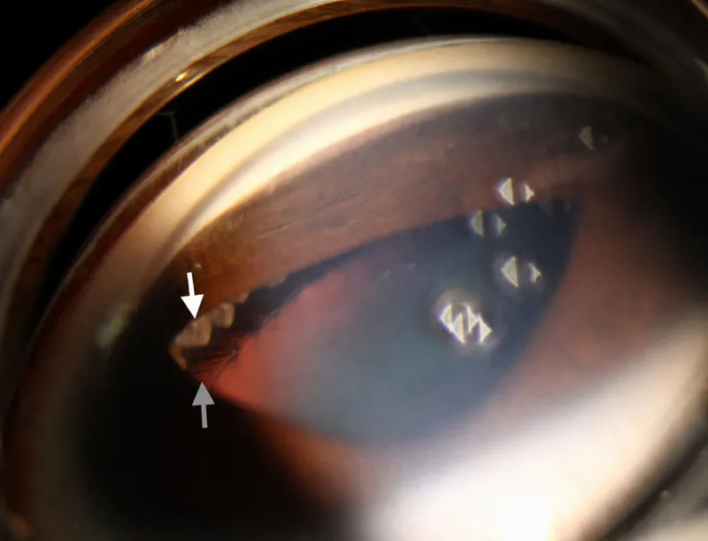 Gonioscopy of peripheral anterior synechiae