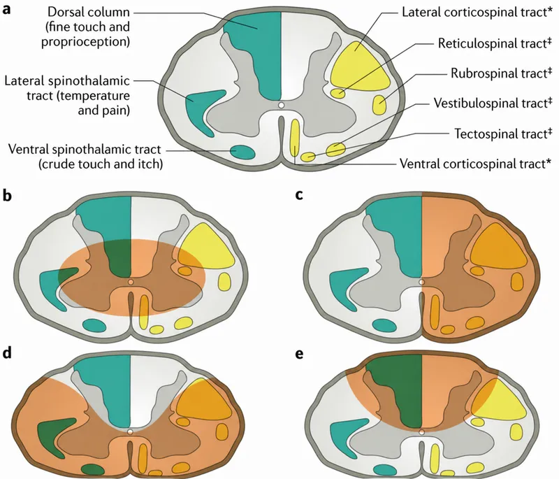 Spinal Cord Tracts & Injury Syndromes