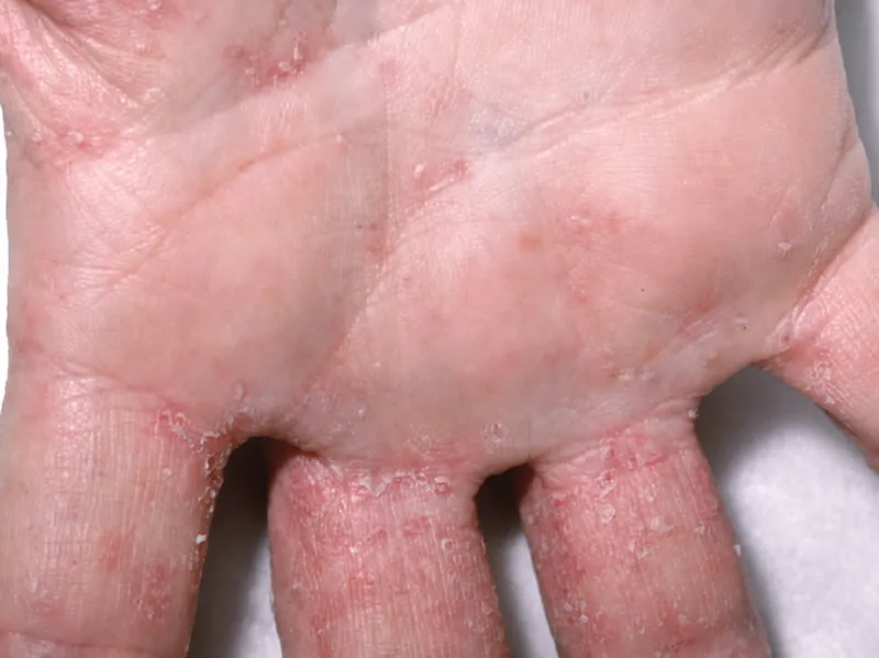 Scabies burrows on child's hand