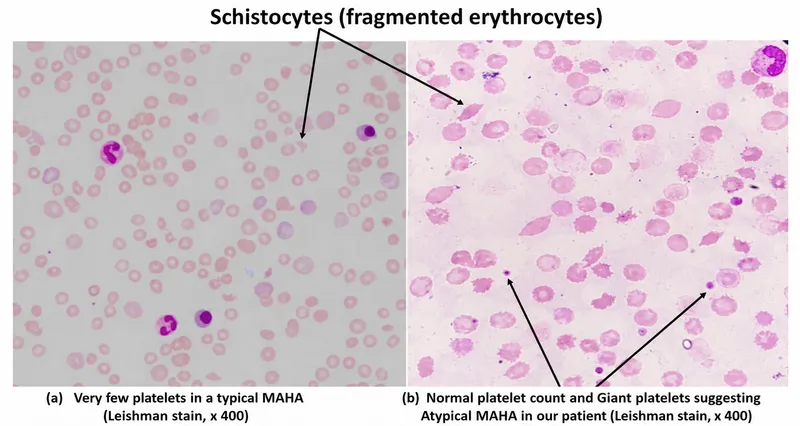 Schistocytes in MAHA peripheral blood smear