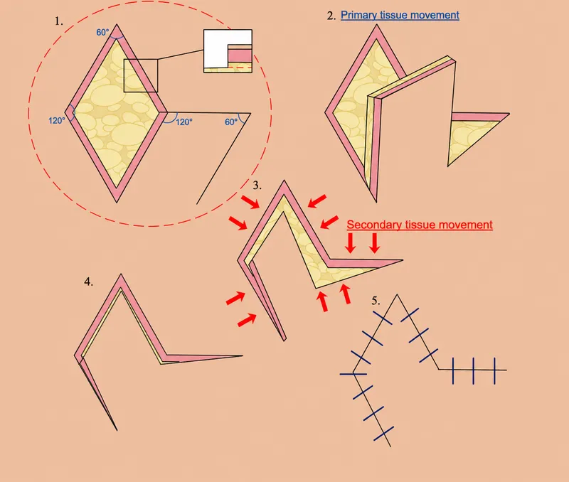 Rhomboid flap design and tissue movement