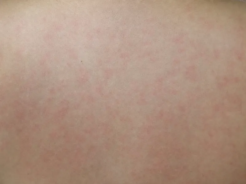 Ampicillin rash in Epstein-Barr virus infection