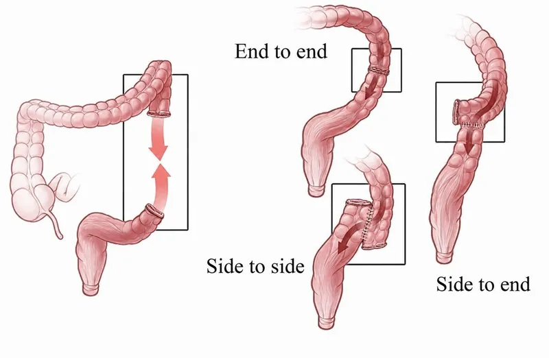 Types of Intestinal Anastomosis