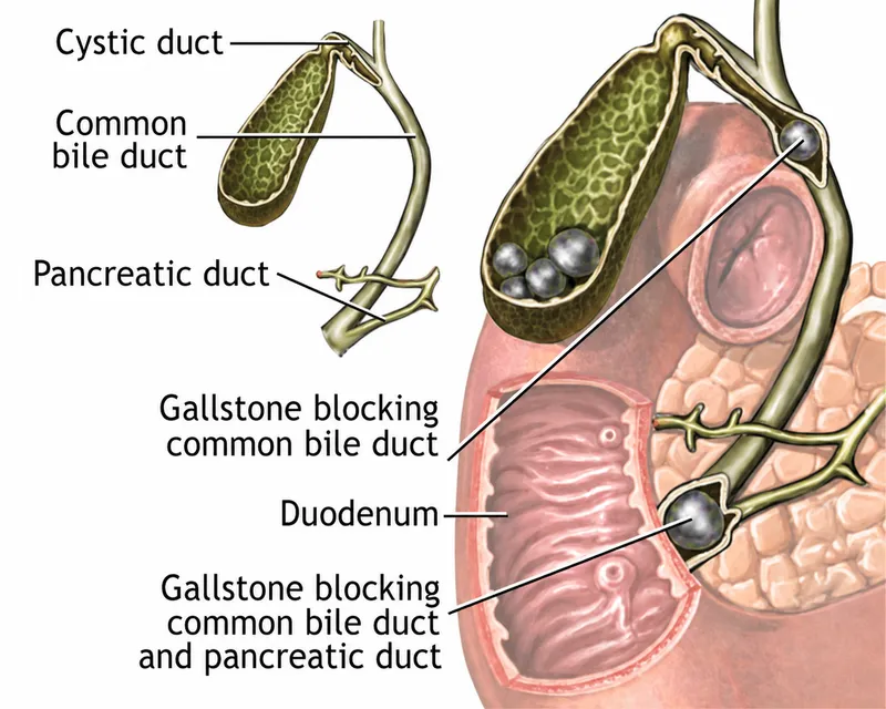 Gallstones blocking bile and pancreatic ducts