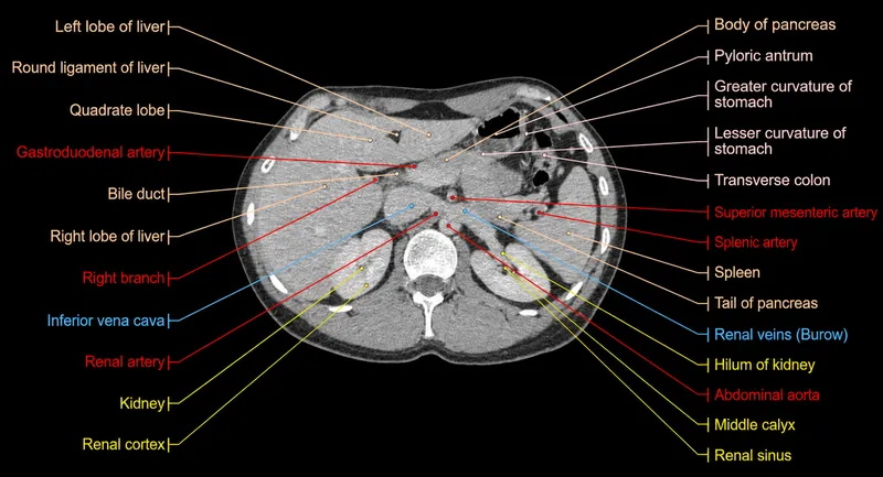 Axial CECT abdomen with pancreatic and surrounding anatomy