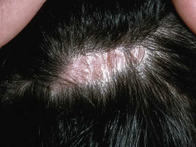 Lichen Planopilaris: Perifollicular erythema/scaling
