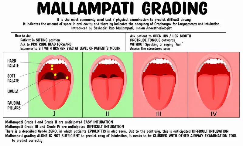 Mallampati Classification Scores I-IV for Airway Assessment