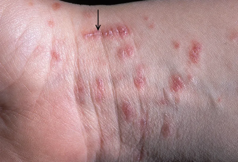 Comparison chart showing diagnostic features of major parasitic skin infections