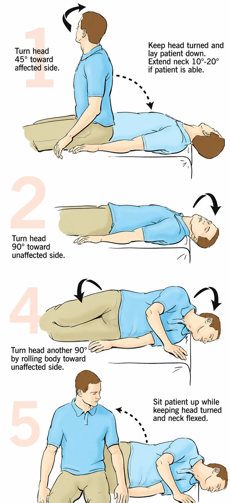 Epley Maneuver for BPPV