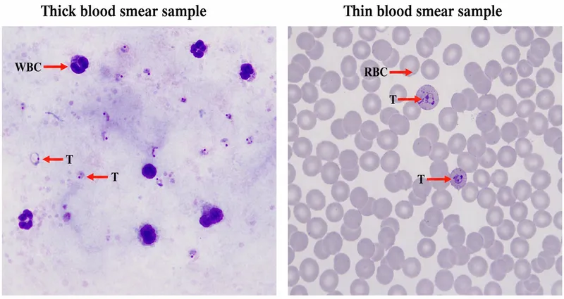 malaria blood smear