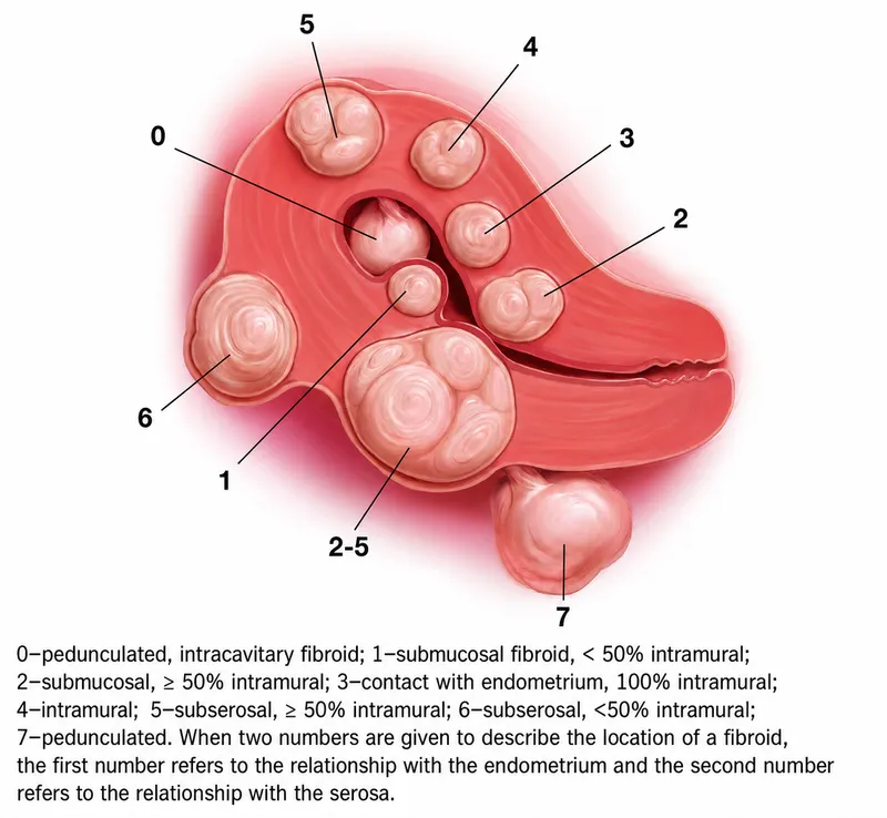 FIGO classification of uterine leiomyomata