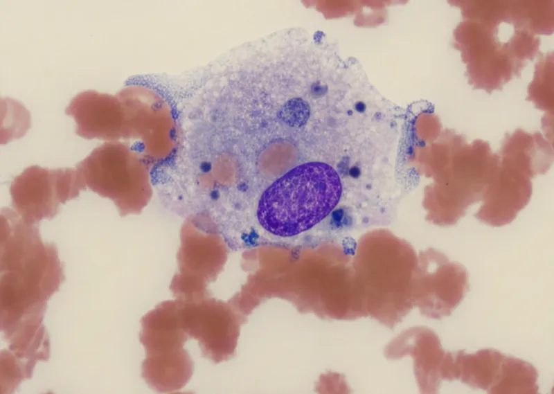 HLH bone marrow aspirate with hemophagocytosis
