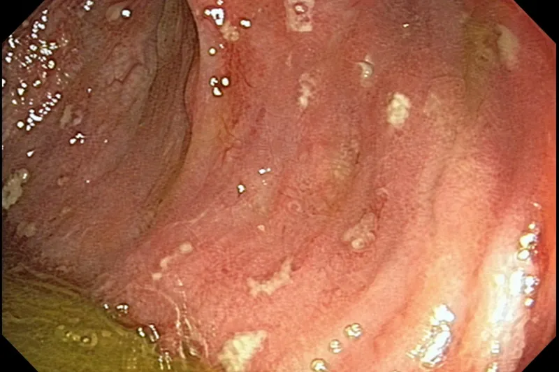 Pseudomembranes in C. difficile colitis
