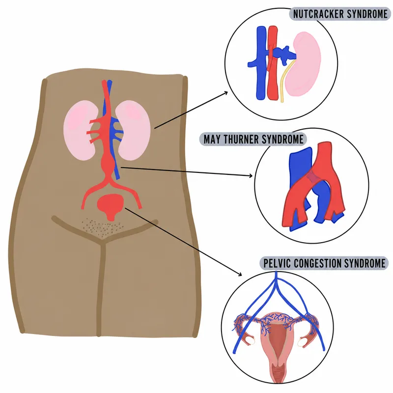 Pelvic Venous Disorders: Nutcracker, May-Thurner, Congestion