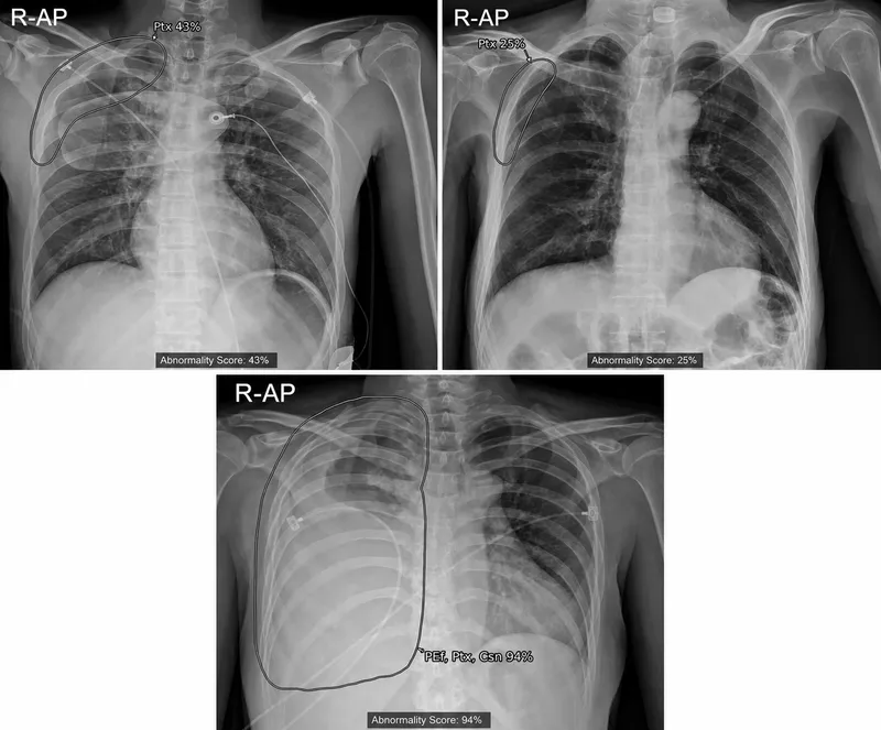 AI detecting pneumothorax on chest X-ray
