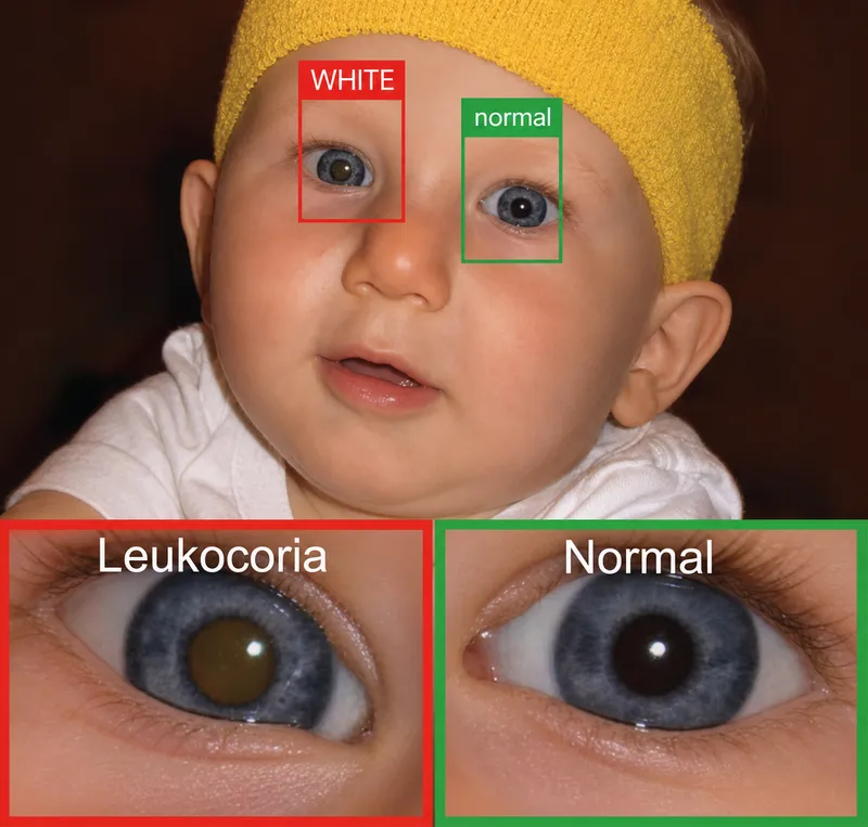 Leukocoria vs Normal Red Reflex in Infant