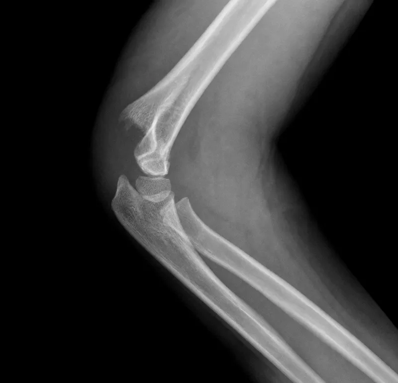 Pediatric supracondylar humerus fracture X-ray