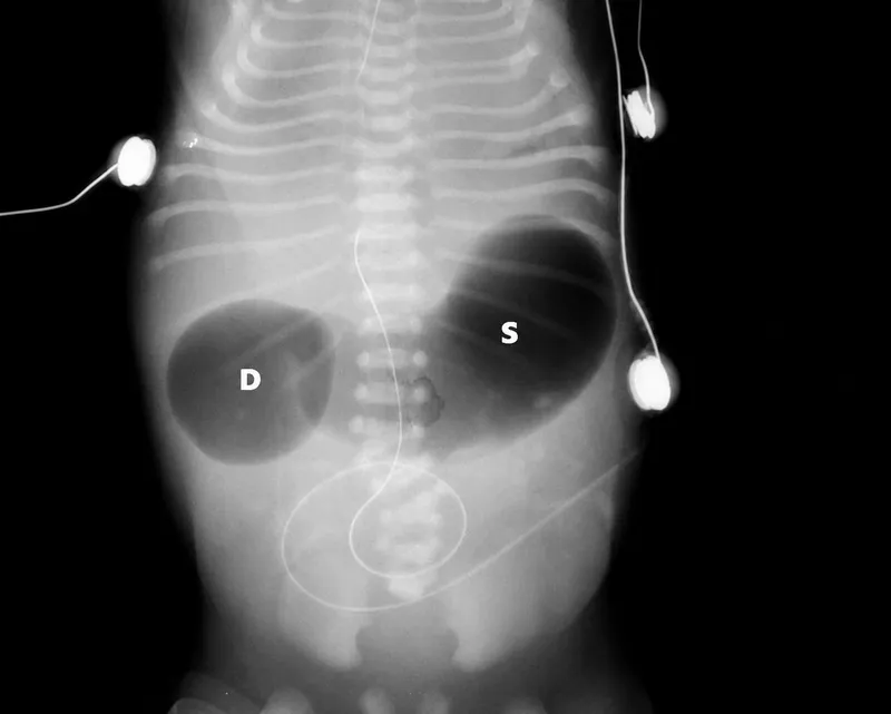 Duodenal Atresia Double Bubble Sign X-ray