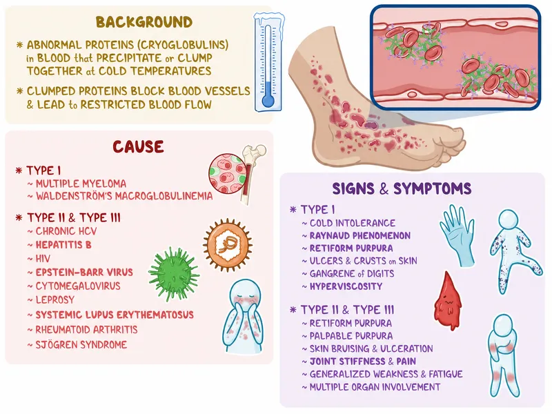 Cryoglobulinemia: Causes, Symptoms, and Pathophysiology