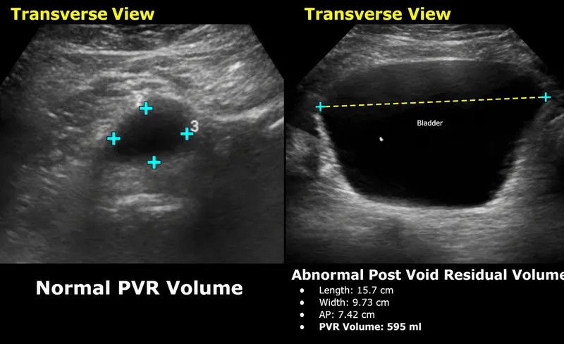 Normal vs. Abnormal Post-Void Residual Volume Ultrasound