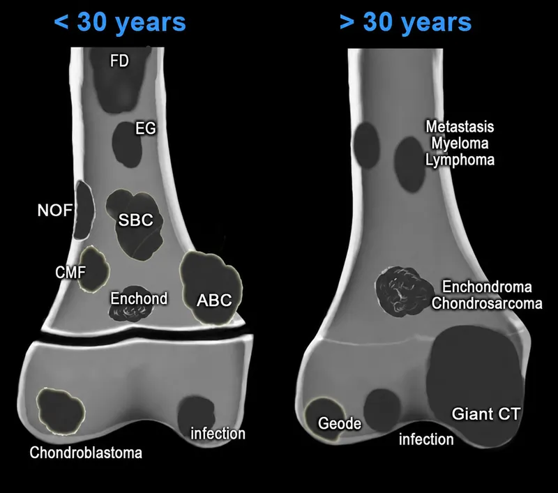 Bone Tumors by Age: Benign vs Malignant