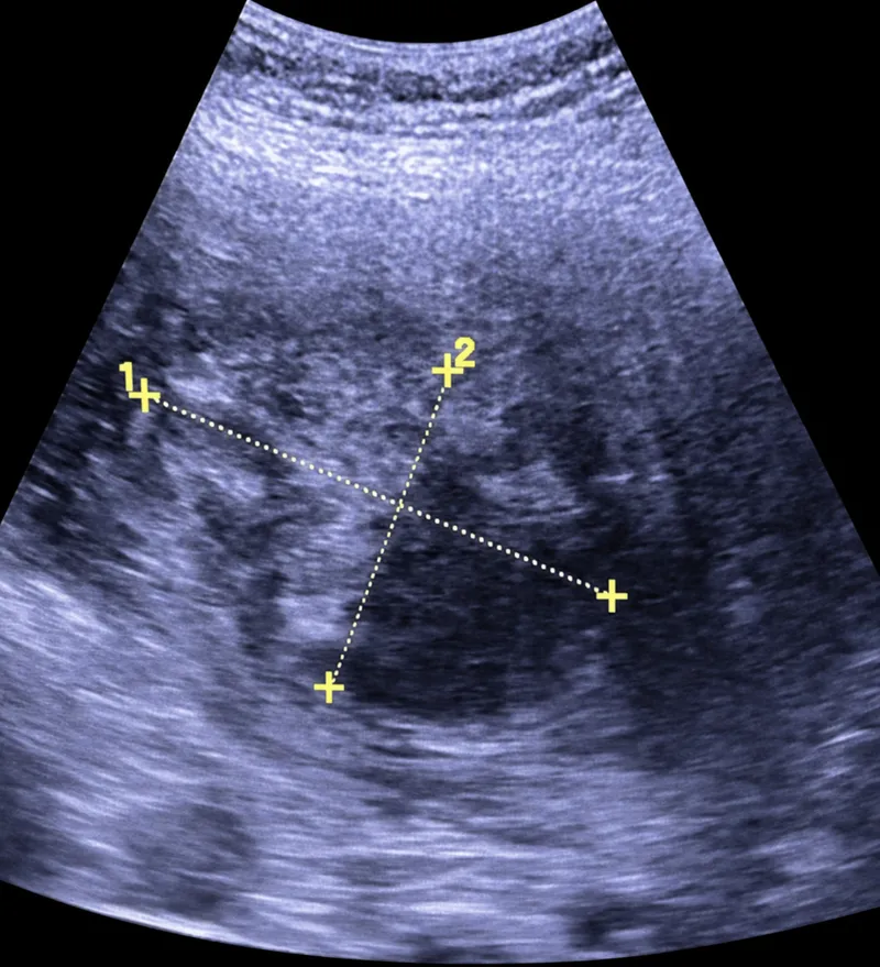Uterine Fibroid Types Ultrasound