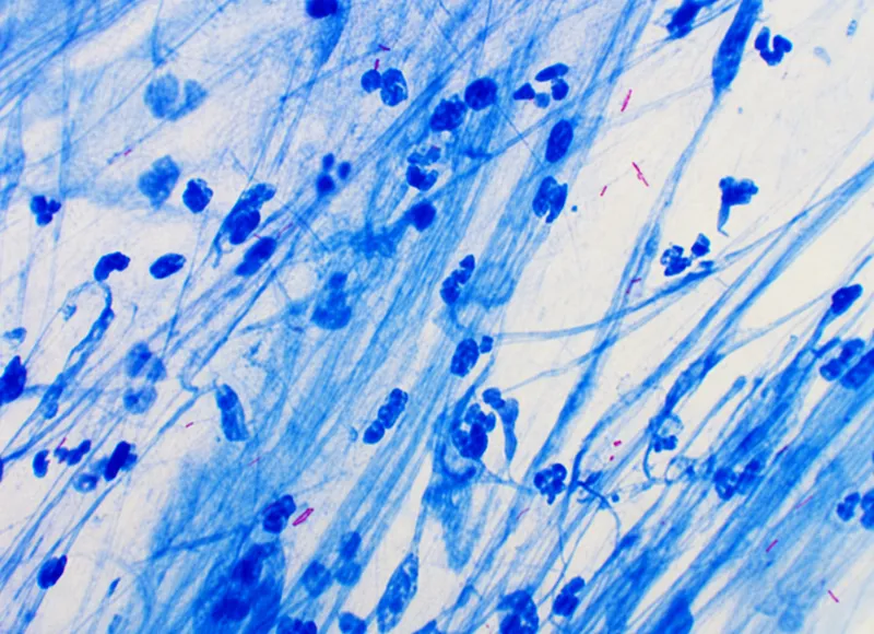 Acid-fast bacilli (Mycobacterium tuberculosis)