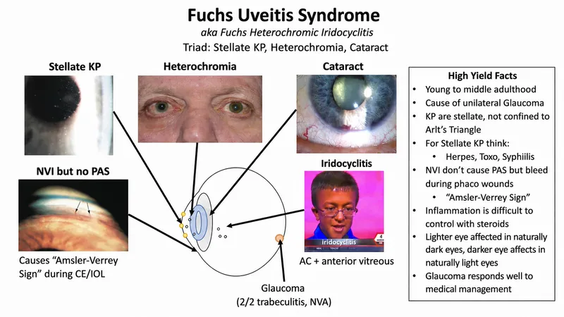Fuchs Uveitis Syndrome Triad and Glaucoma