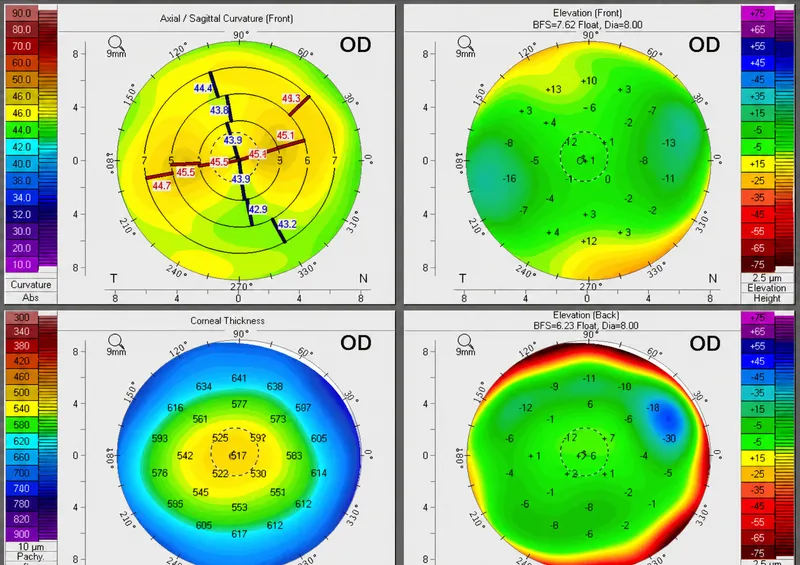 Pentacam 4 Maps Refractive: Regular Astigmatism