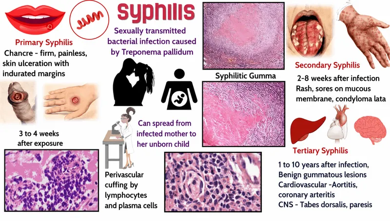 Syphilis stages and pathology overview