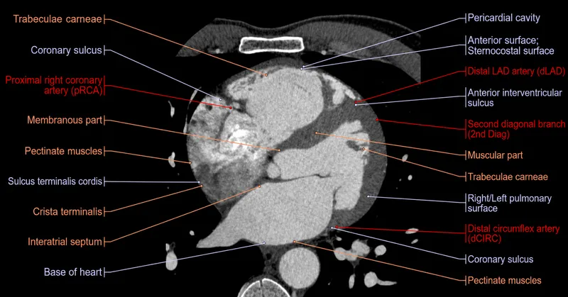 Axial CT cardiac view with labels